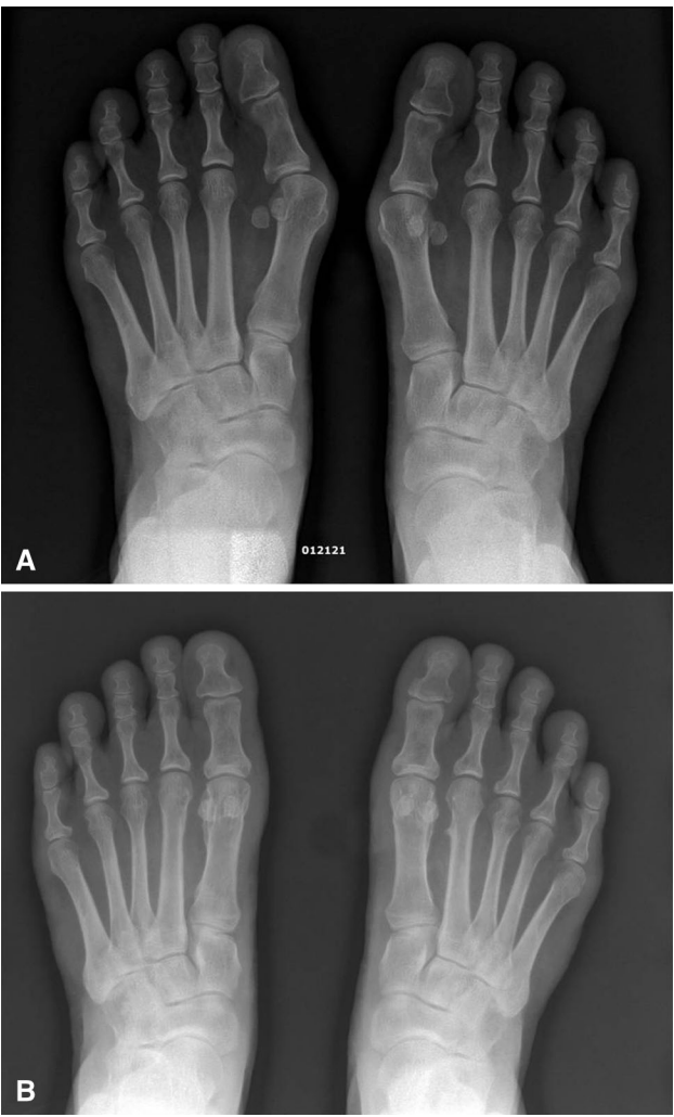 【手术技巧】拇外翻非截骨韧带联合术（Syndesmosis