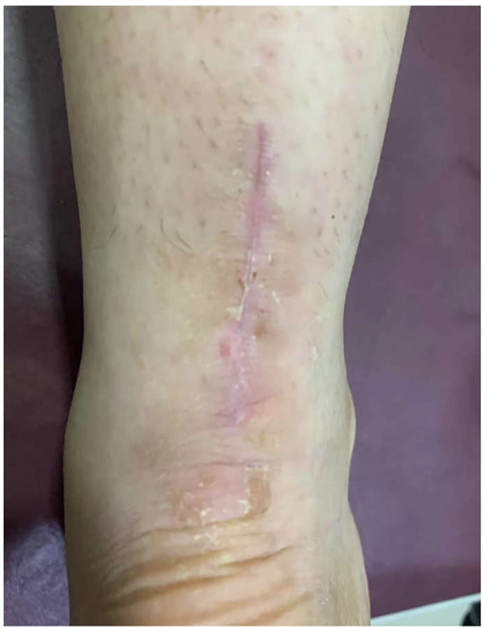 【手术技巧】急性跟腱修复之吊桥技术