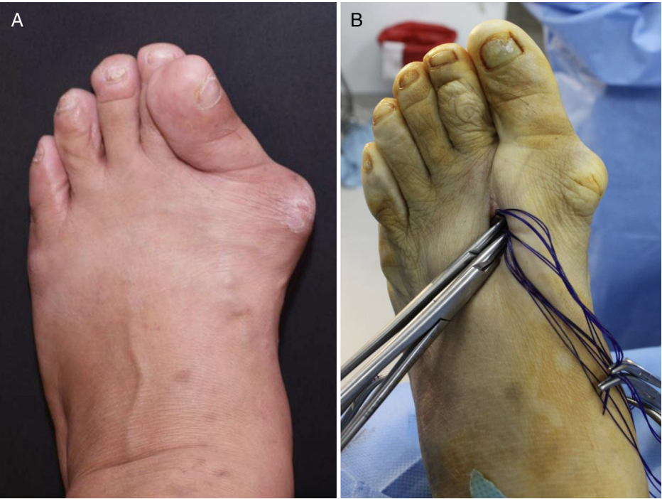 【手术技巧】拇外翻非截骨韧带联合术（Syndesmosis