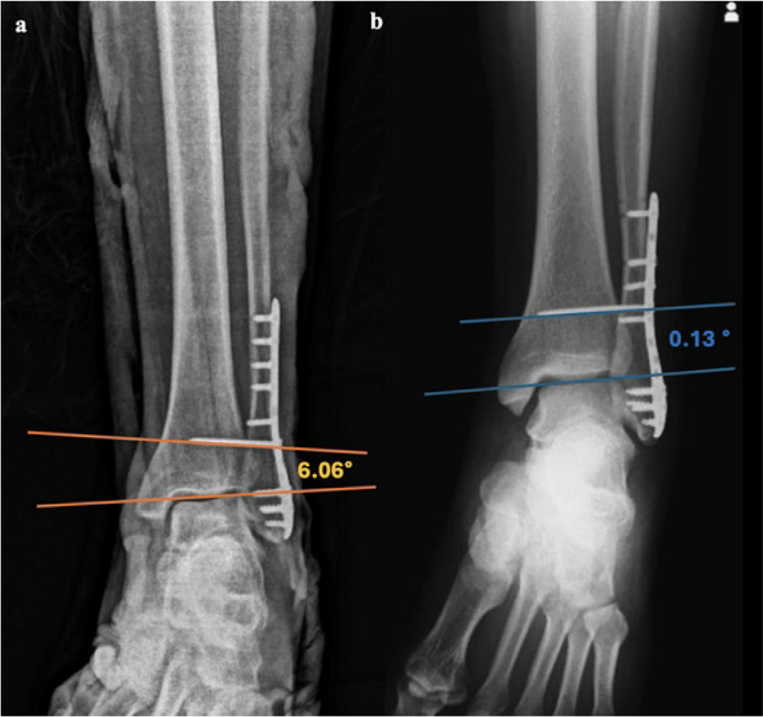 【手术技巧】下胫腓联合螺钉冠状面打歪了要紧不？