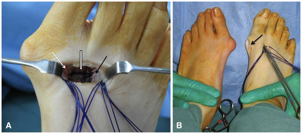 【手术技巧】拇外翻非截骨韧带联合术（Syndesmosis