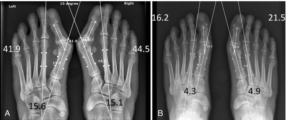 【手术技巧】拇外翻非截骨韧带联合术（Syndesmosis