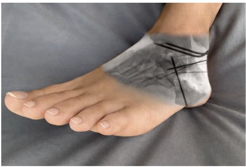 【手术技巧】跟骨骨折的规范操作技术（德国经验）