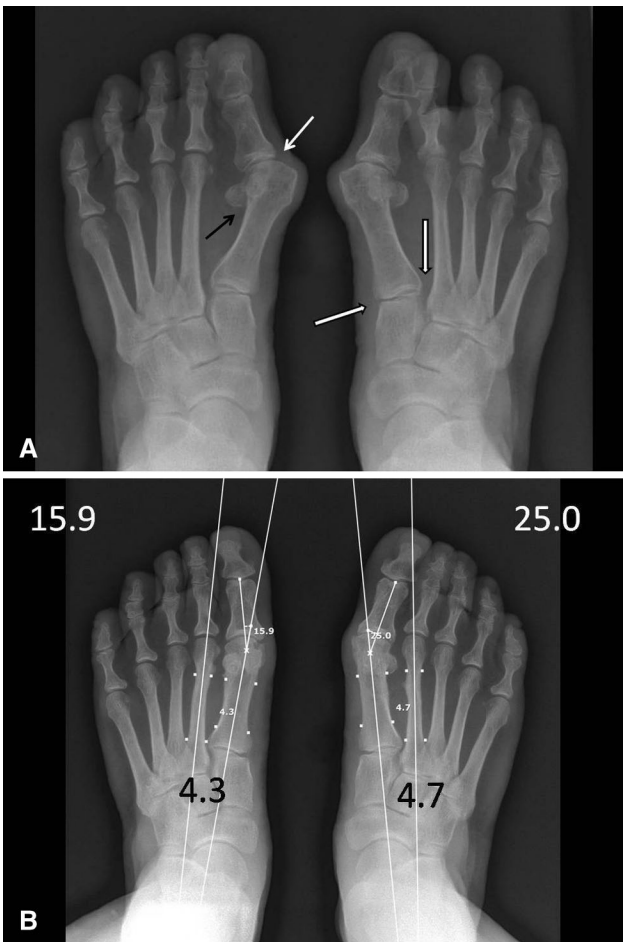 【手术技巧】拇外翻非截骨韧带联合术（Syndesmosis
