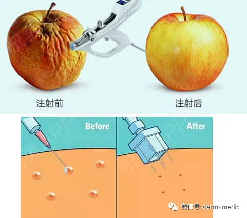 什么是bd针水光针到底是什么_https://www.jmylbn.com_新闻资讯_第4张