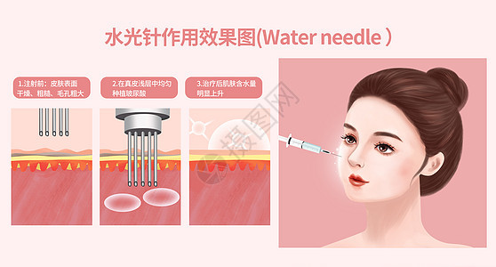 什么是bd针水光针到底是什么_https://www.jmylbn.com_新闻资讯_第3张