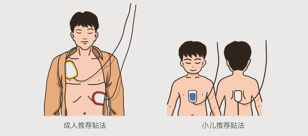 aed自动体外除颤器