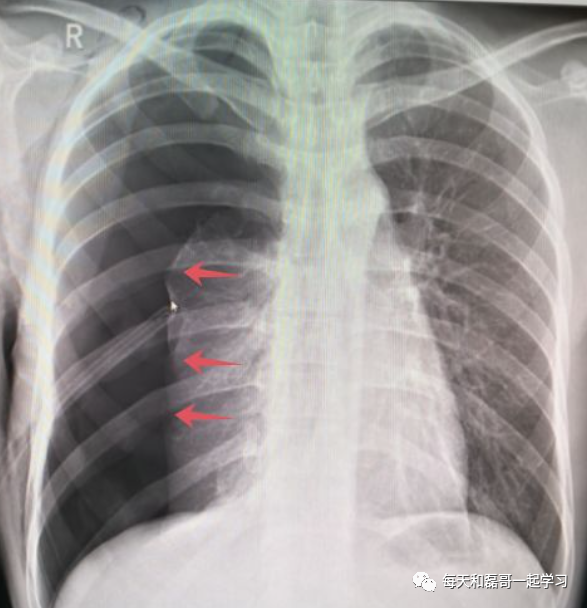 机械通气的指征是什么重症技术之机械通气（二）-指征、禁忌、对心脏前后负荷影响_https://www.jmylbn.com_新闻资讯_第1张