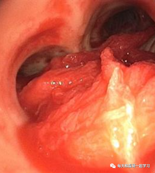 机械通气的指征是什么重症技术之机械通气（二）-指征、禁忌、对心脏前后负荷影响_https://www.jmylbn.com_新闻资讯_第2张