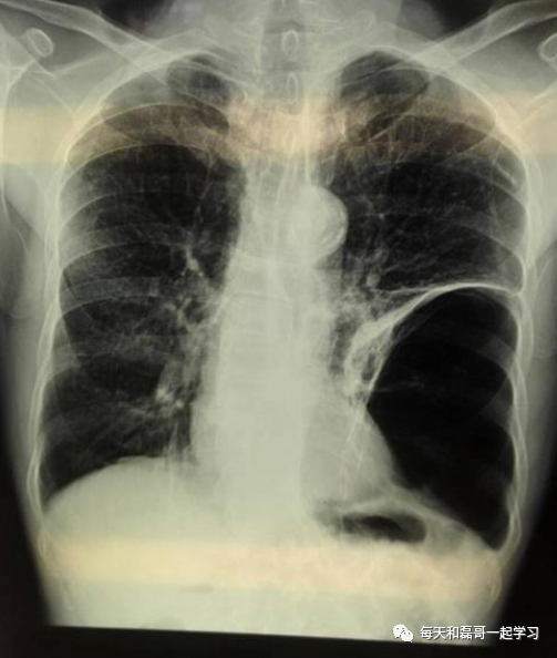 机械通气的指征是什么重症技术之机械通气（二）-指征、禁忌、对心脏前后负荷影响_https://www.jmylbn.com_新闻资讯_第3张