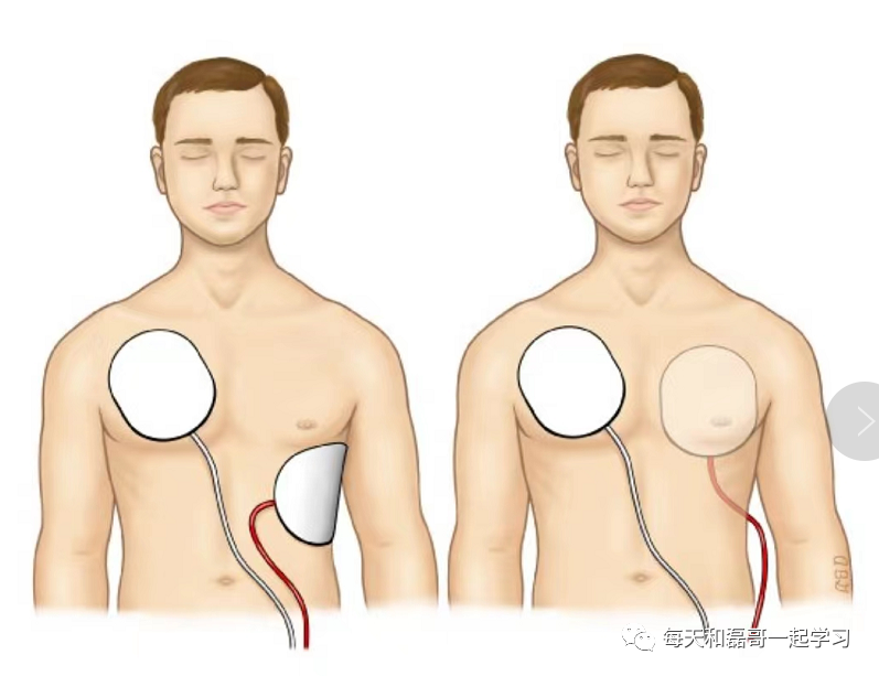为什么选择双相波重症技术之电复律、除颤术（一）_https://www.jmylbn.com_新闻资讯_第6张