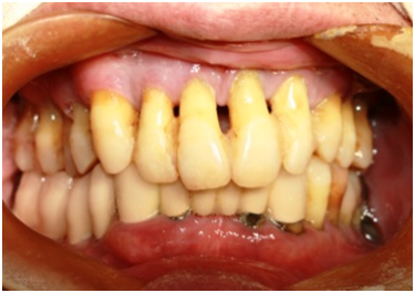 数字牙片机怎么用【推广】数字化技术让口腔种植更精准_https://www.jmylbn.com_新闻资讯_第3张
