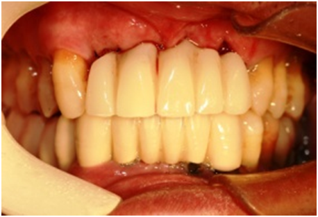 数字牙片机怎么用【推广】数字化技术让口腔种植更精准_https://www.jmylbn.com_新闻资讯_第4张