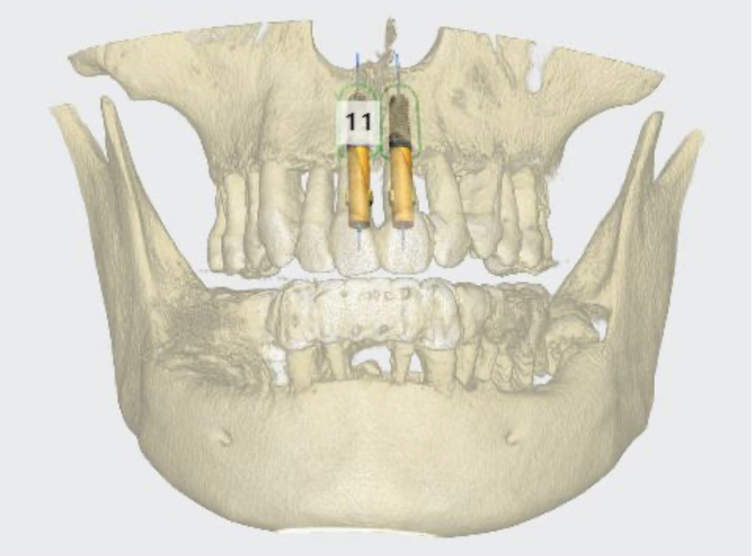 数字牙片机怎么用【推广】数字化技术让口腔种植更精准_https://www.jmylbn.com_新闻资讯_第5张