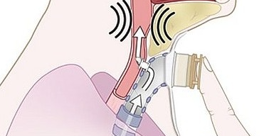 呼吸机湿化罐怎么加水谢克亮教授：ICU机械通气中的湿化与感控_https://www.jmylbn.com_新闻资讯_第4张