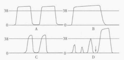 病人监测仪怎么看小小曲线，大大奥秘｜监护仪上每天都看的SpO2与PETCO2，除了数值还要关注什么？_https://www.jmylbn.com_新闻资讯_第4张