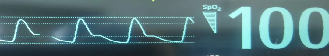 病人监测仪怎么看小小曲线，大大奥秘｜监护仪上每天都看的SpO2与PETCO2，除了数值还要关注什么？_https://www.jmylbn.com_新闻资讯_第2张