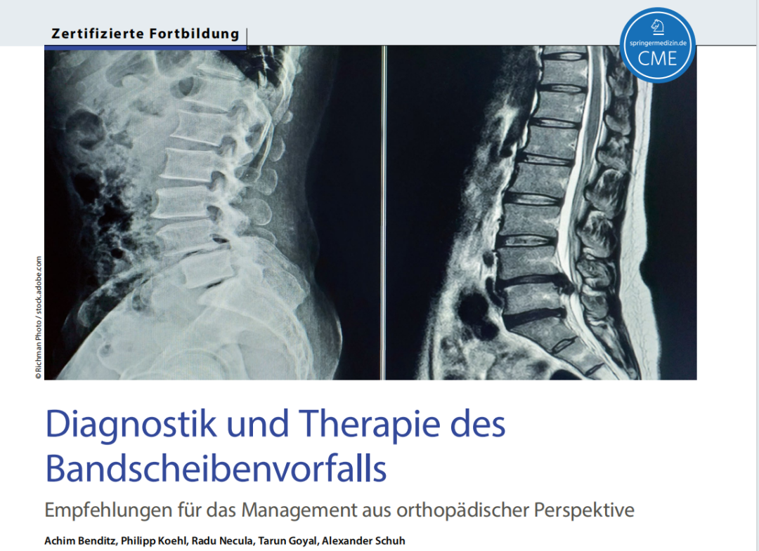 椎间盘突出症的诊断与治疗