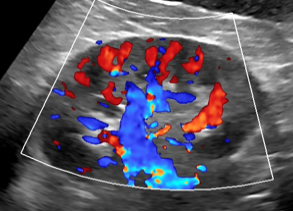 彩超伪像是什么读懂“B超”——无创影像之超声检查_https://www.jmylbn.com_新闻资讯_第4张