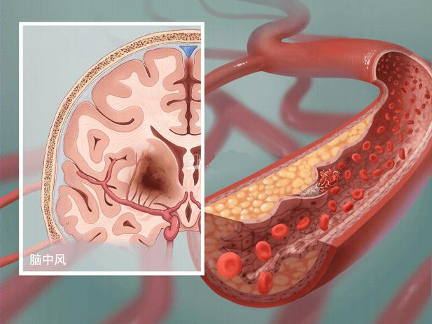 动脉硬化怎么检测动脉硬化检测仪——血管硬化的“照妖镜”_https://www.jmylbn.com_新闻资讯_第6张