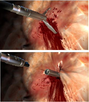 内镜夹怎么不掉切完息肉后，留在肚子里的“金属夹子”，最后去哪儿了？_https://www.jmylbn.com_新闻资讯_第2张