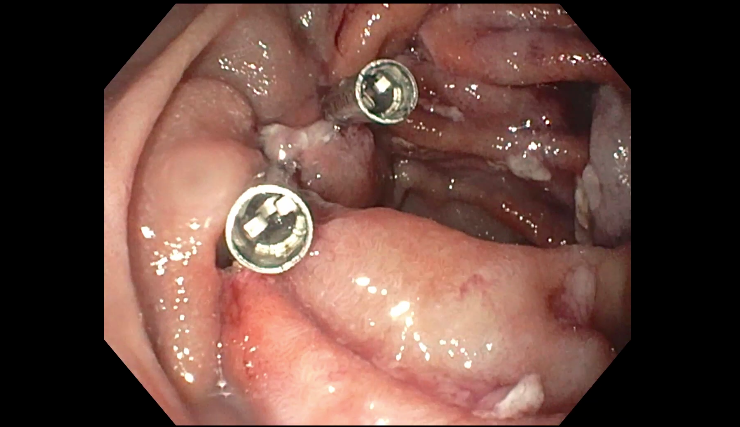 内镜夹怎么不掉切完息肉后，留在肚子里的“金属夹子”，最后去哪儿了？_https://www.jmylbn.com_新闻资讯_第4张