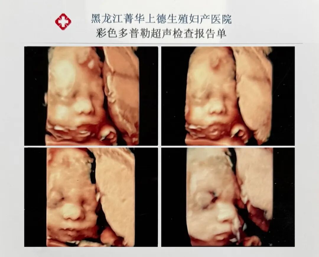 VOlusonE什么彩超机刷爆哈尔滨孕妈圈的GE-E22四维彩超，到底有多神奇？_https://www.jmylbn.com_新闻资讯_第3张