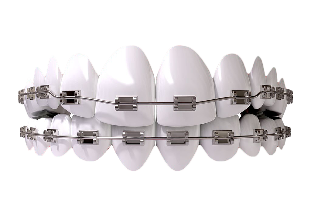 正畸颊面管是什么牙齿矫正，一根弓丝是怎么“工作”的？_https://www.jmylbn.com_新闻资讯_第10张