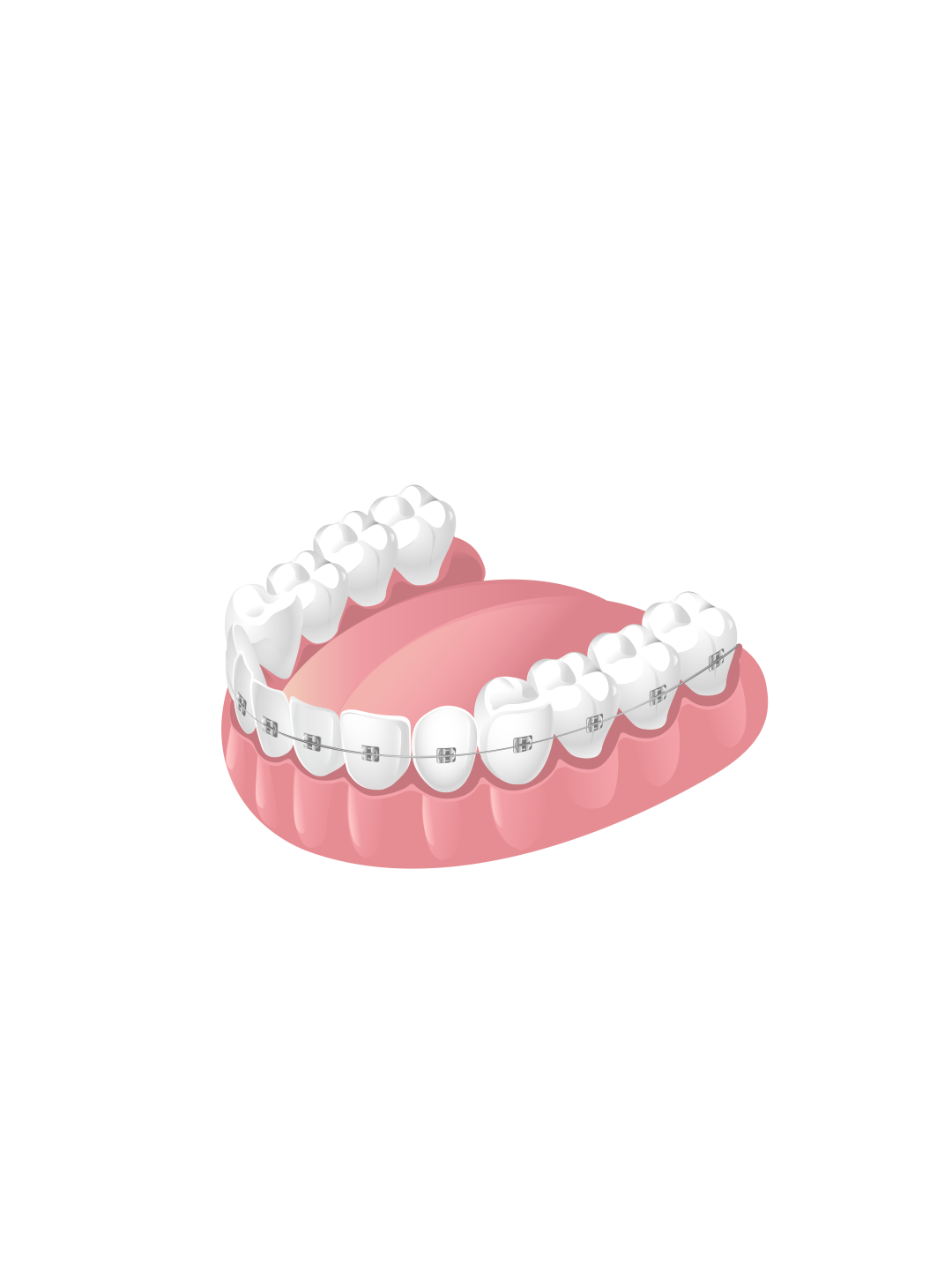 正畸颊面管是什么牙齿矫正，一根弓丝是怎么“工作”的？_https://www.jmylbn.com_新闻资讯_第11张