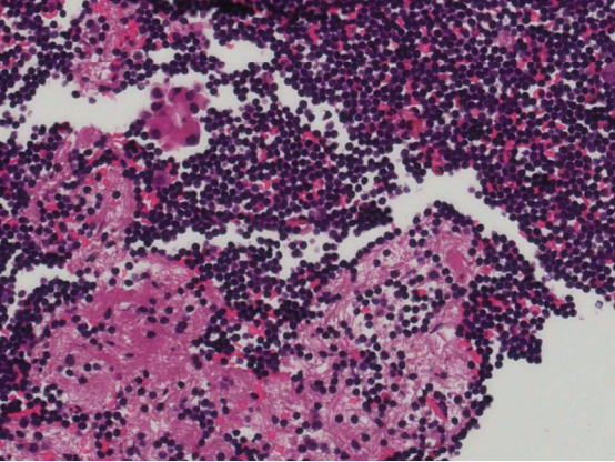 什么是病理蜡块病理新技术之“细胞蜡块”，让胸腹水中查找恶性细胞从“大海捞针”到“探囊取物”！_https://www.jmylbn.com_新闻资讯_第3张