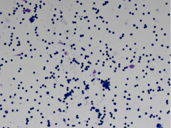 什么是病理蜡块病理新技术之“细胞蜡块”，让胸腹水中查找恶性细胞从“大海捞针”到“探囊取物”！_https://www.jmylbn.com_新闻资讯_第2张