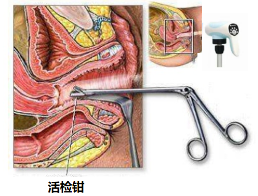 宫颈活检取样怎么取宫颈癌二级预防（筛查）_https://www.jmylbn.com_新闻资讯_第10张