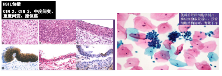 宫颈活检取样怎么取宫颈癌二级预防（筛查）_https://www.jmylbn.com_新闻资讯_第11张