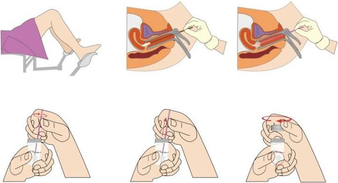 宫颈活检取样怎么取宫颈癌二级预防（筛查）_https://www.jmylbn.com_新闻资讯_第4张