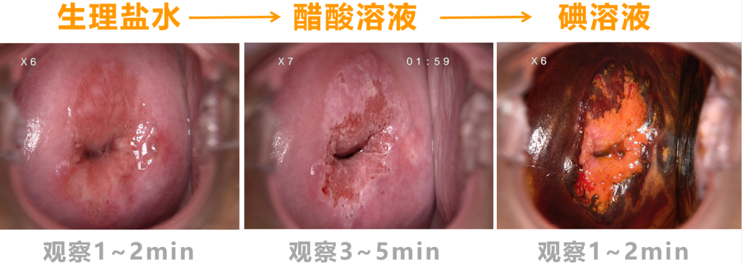宫颈活检取样怎么取宫颈癌二级预防（筛查）_https://www.jmylbn.com_新闻资讯_第6张