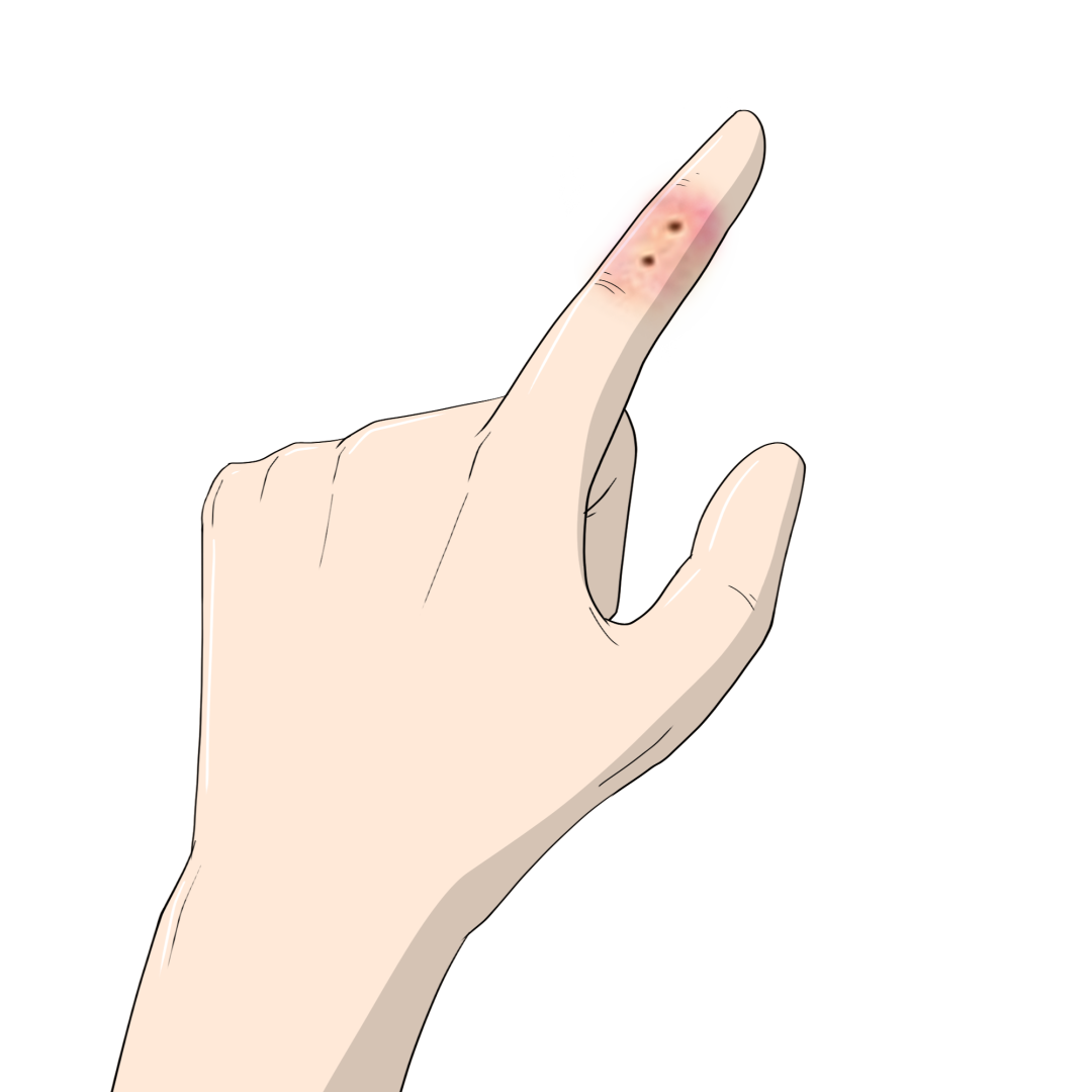 单质银为什么能抗菌“小伤口”也能致死？伤口消毒用什么，看这一篇就够了！_https://www.jmylbn.com_新闻资讯_第15张