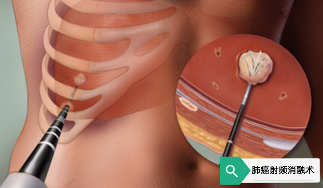 手术消融电极怎么用介入微创疗法——肺癌的射频消融术【海河科普】_https://www.jmylbn.com_新闻资讯_第5张