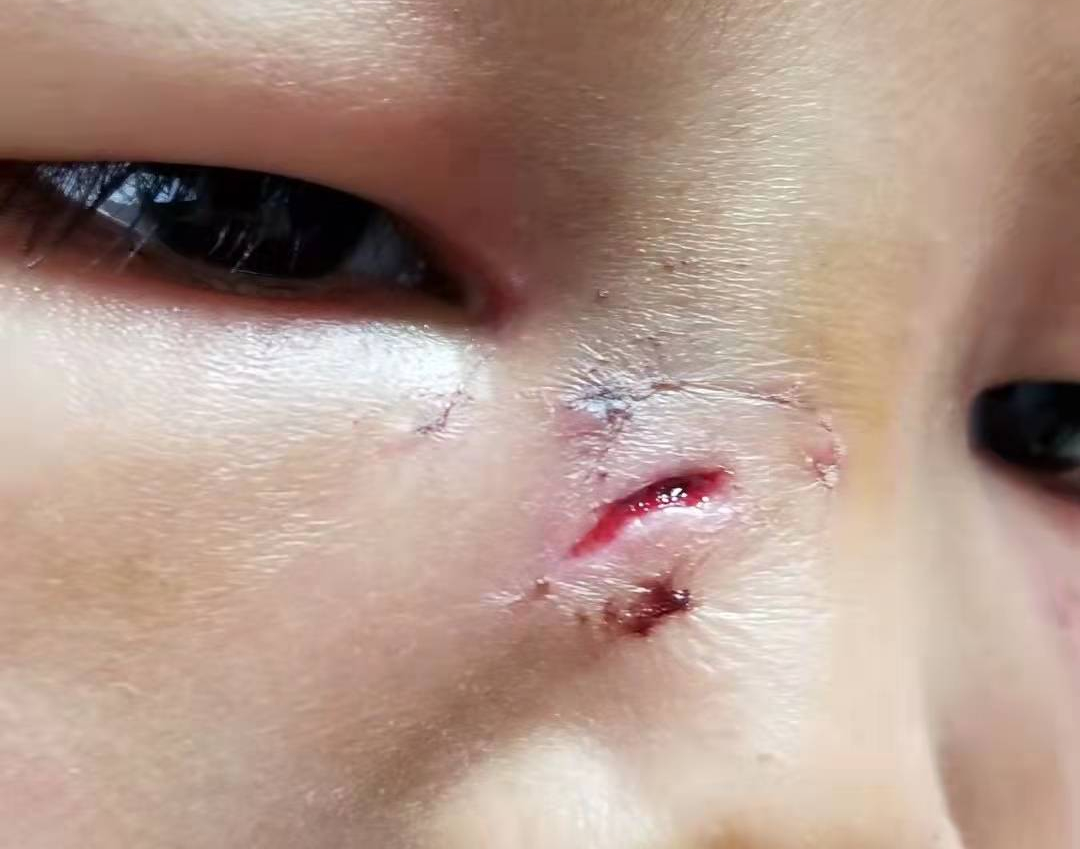 医用凡士林敷料怎么用6岁女童在小区摸了下竹子，手掌被扎了200根刺！孩子的妈妈用各种“偏方”拔刺：醋泡、用瓶子吸、针挑、胶布粘……手掌差点报废_https://www.jmylbn.com_新闻资讯_第19张