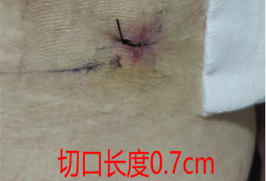 开刀孔怎么开刀优势学科｜精准 微创 高效——市二医院脊柱外科运用椎间孔镜技术，不开刀轻松解决88岁老人腰腿疼痛_https://www.jmylbn.com_新闻资讯_第6张