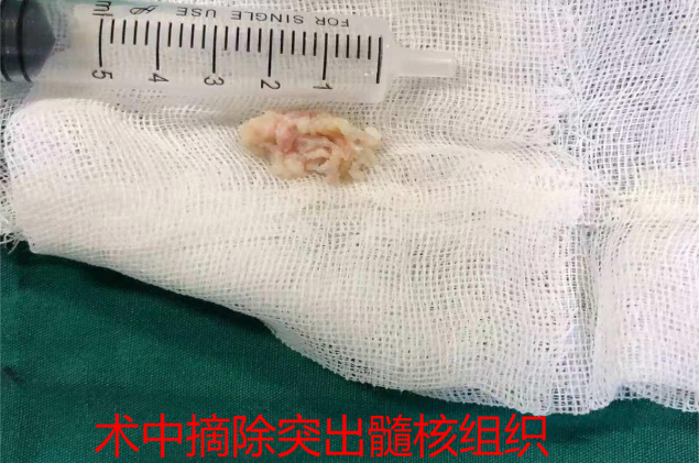 开刀孔怎么开刀优势学科｜精准 微创 高效——市二医院脊柱外科运用椎间孔镜技术，不开刀轻松解决88岁老人腰腿疼痛_https://www.jmylbn.com_新闻资讯_第4张