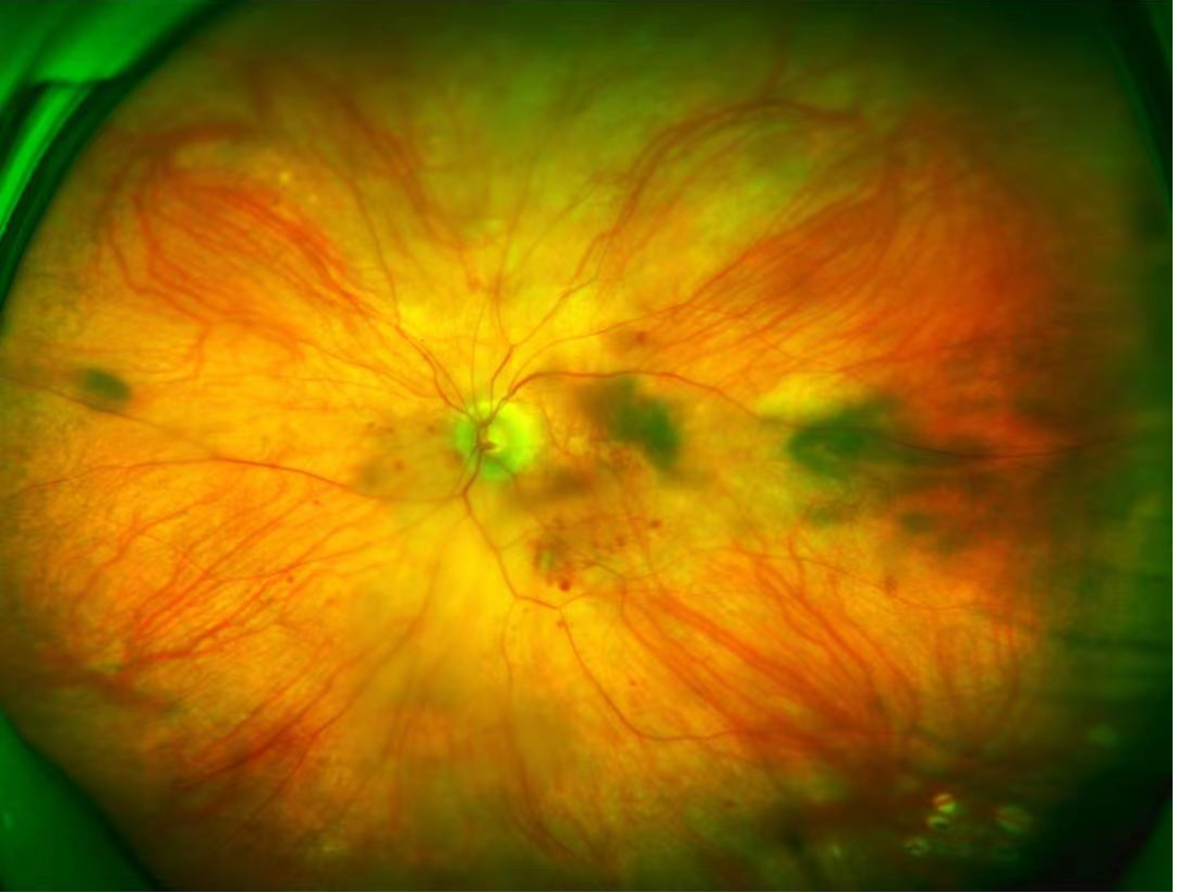 眼底照相机怎么眼底一张照  眼疾早知道——我院眼科引进欧宝超广角眼底照像机_https://www.jmylbn.com_新闻资讯_第24张