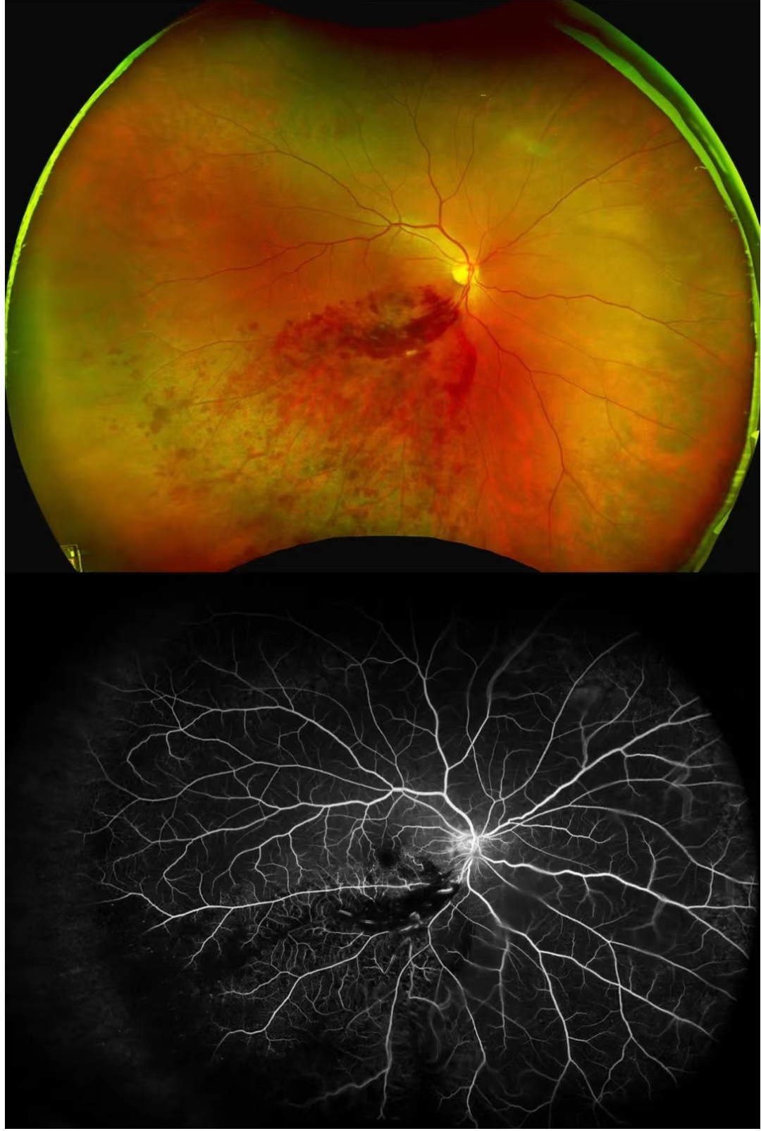 眼底照相机怎么眼底一张照  眼疾早知道——我院眼科引进欧宝超广角眼底照像机_https://www.jmylbn.com_新闻资讯_第22张