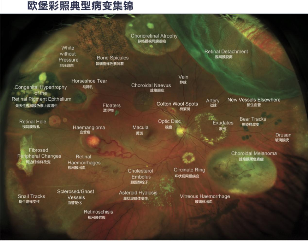 眼底照相机怎么眼底一张照  眼疾早知道——我院眼科引进欧宝超广角眼底照像机_https://www.jmylbn.com_新闻资讯_第8张
