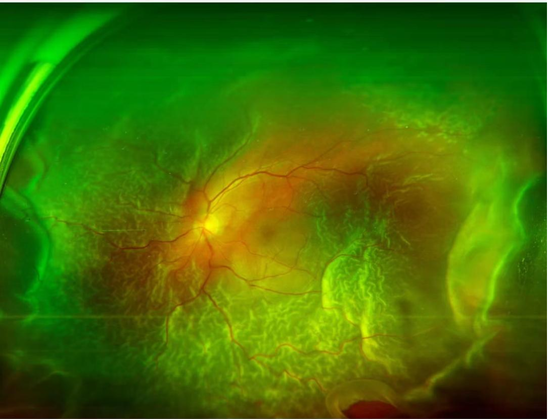 眼底照相机怎么眼底一张照  眼疾早知道——我院眼科引进欧宝超广角眼底照像机_https://www.jmylbn.com_新闻资讯_第21张