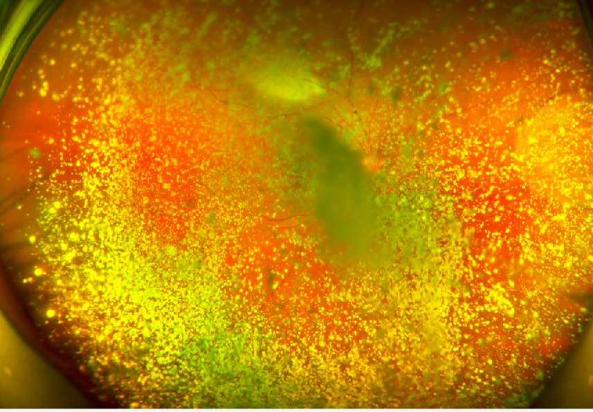 眼底照相机怎么眼底一张照  眼疾早知道——我院眼科引进欧宝超广角眼底照像机_https://www.jmylbn.com_新闻资讯_第23张