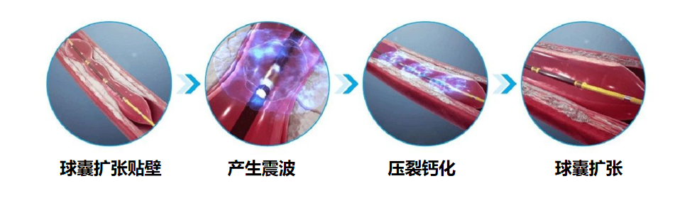 什么是外周支架【长海临研】新技术治疗下肢动脉硬化闭塞症及下肢深静脉血栓（经济舱综合）临床试验患者招募_https://www.jmylbn.com_新闻资讯_第3张