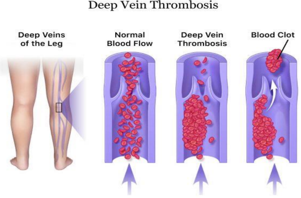 什么是外周支架【长海临研】新技术治疗下肢动脉硬化闭塞症及下肢深静脉血栓（经济舱综合）临床试验患者招募_https://www.jmylbn.com_新闻资讯_第4张