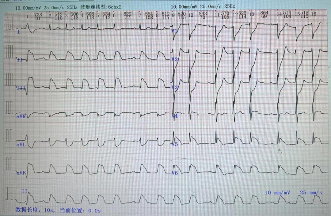 十二道心电图怎么检查好消息！我院可开展十八导联心电图检查啦！_https://www.jmylbn.com_新闻资讯_第8张