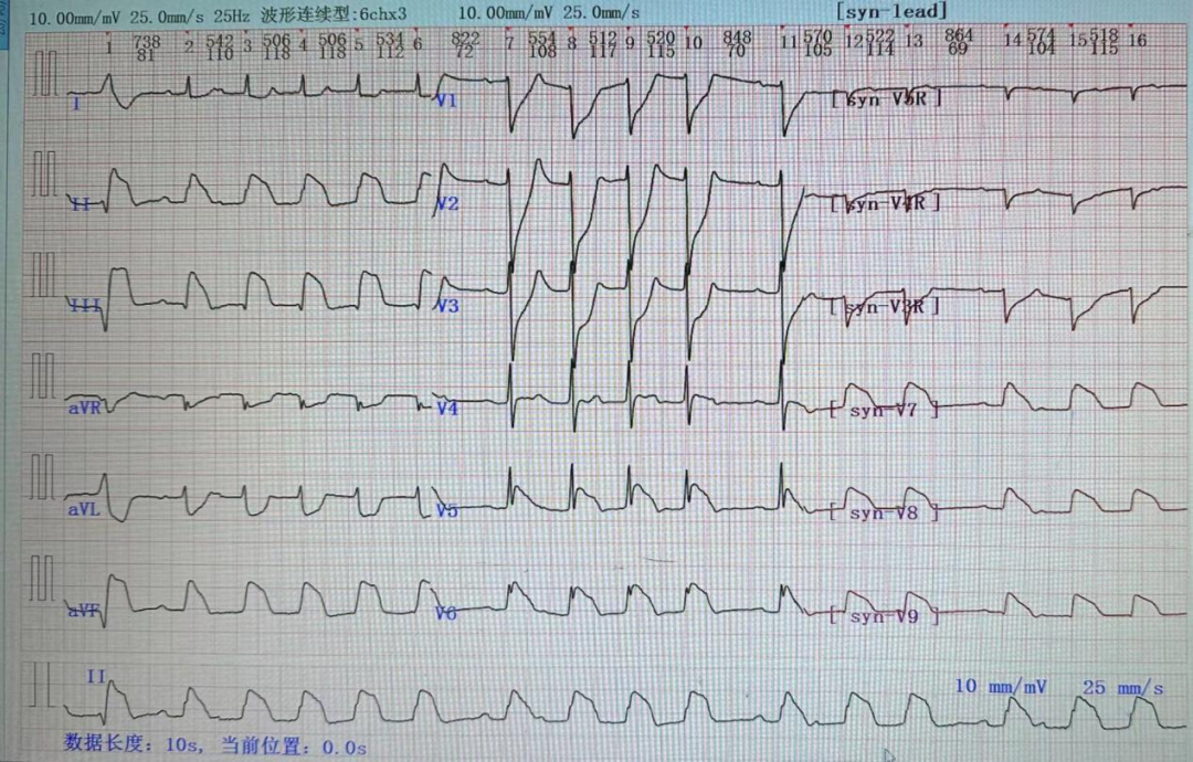 十二道心电图怎么检查好消息！我院可开展十八导联心电图检查啦！_https://www.jmylbn.com_新闻资讯_第9张