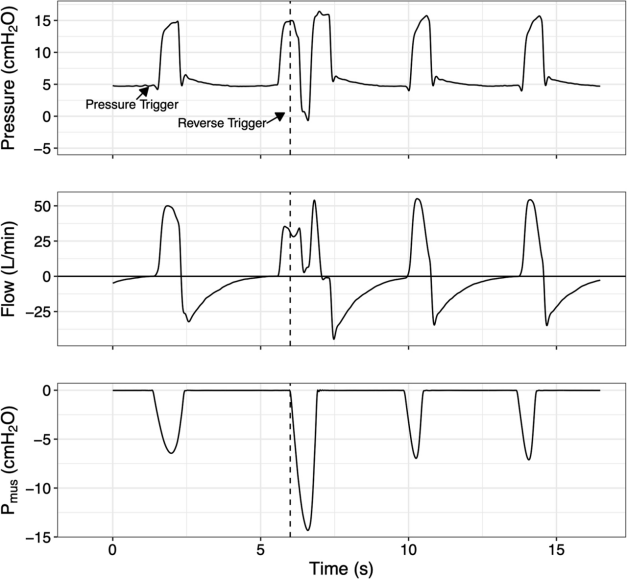为什么呼吸机人机同步读书报告｜在呼吸机显示器上同时显示估计肌肉压力曲线对医疗保健专业人员正确识别人机不同步的影响：一项随机研究_https://www.jmylbn.com_新闻资讯_第7张